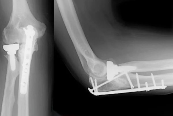 Complex Fracture Management