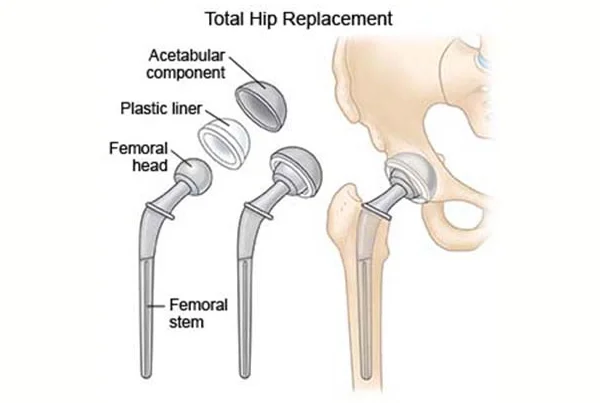 Hip Replacement