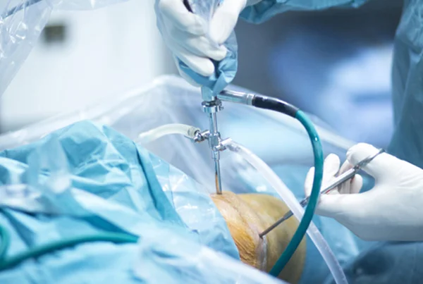 Arthroscopic Ligament Reconstruction