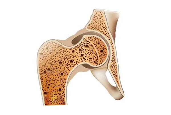 Osteoporosis Treatment
